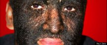 Edmund Burke’s Dreamboat Wolf Boy Larry Gomez Hopes New Genetic Findings Can Care ‘Werewolf Syndrome Huffingpost.com 